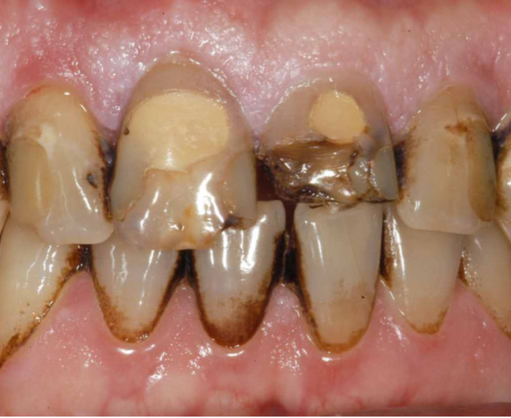 denti di paziente che hanno necessità di un trattamento dentistico